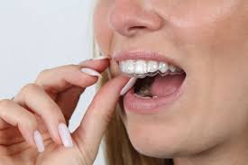 Clear Aligner