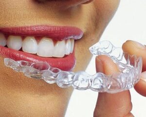Clear Aligner